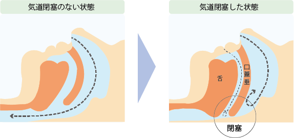 息苦しい 仰向け